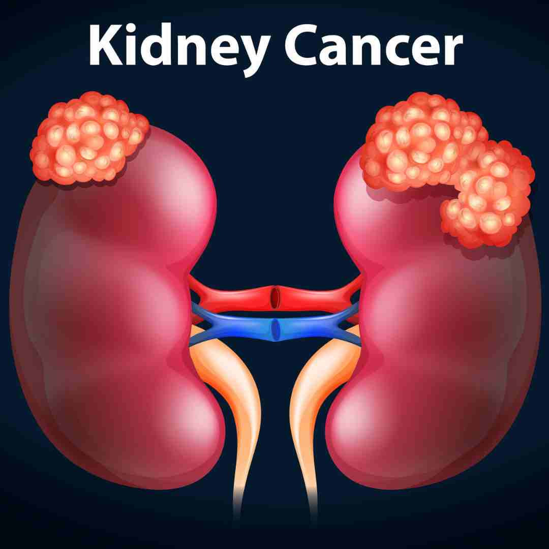 Kidney Cancer Kidney cancer